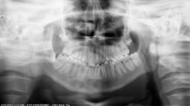 Panoramic radiograph with small, blurred lower incisors and the cervical spine over the ramus
