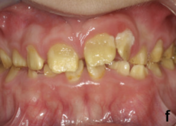 Hypocalcified amelogenesis imperfecta