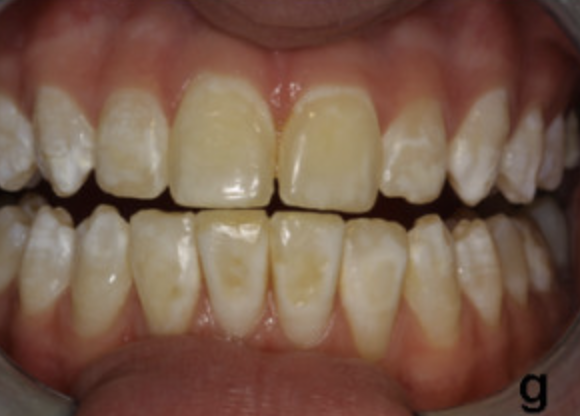 Hypomaturation amelogenesis imperfecta